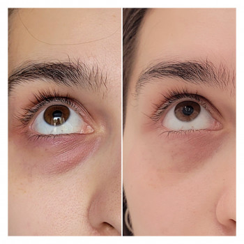 Нижня транскон'юнктивальна блефаропластика, 4 доба