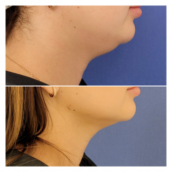 - шприцева ліпосакція підборіддя