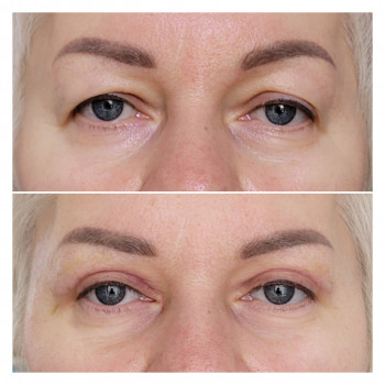 -верхня блефаропластика, 7 доба після операції