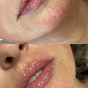 Збільшення губ препаратом Juvederm Ultra Smile
                    Косметолог Катерина Вінниця