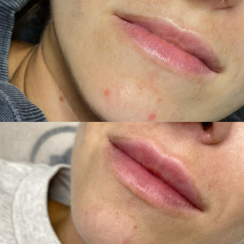 Збільшення губ препаратом Juvederm Ultra Smile
                    Косметолог Катерина Вінниця