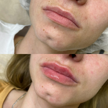 Збільшення губ препаратом Juvederm Ultra Smile
                    Косметолог Катерина Вінниця