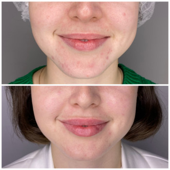 Збільшення губ препаратом Juvederm Ultra Smile
                    Косметолог Катерина Вінниця
