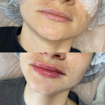 Збільшення губ препаратом Juvederm Ultra Smile
                    Косметолог Катерина Вінниця