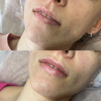 Збільшення губ препаратом Juvederm Ultra Smile
                    Косметолог Катерина Вінниця