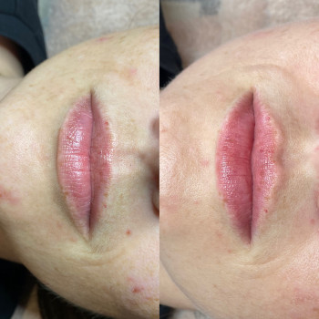 Збільшення губ препаратом Juvederm Ultra Smile
                    Косметолог Катерина Вінниця