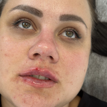 Після натуральне збільшення губ