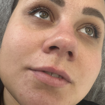 До процедури