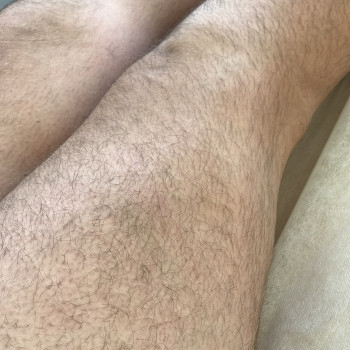 Фото ніг «до» воскової депіляції