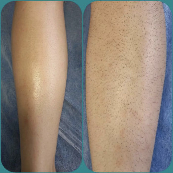 Видалення волосся воском, шпательна техніка. Результат до 2 тижнів. Потім волосся, зменшується у кіл...