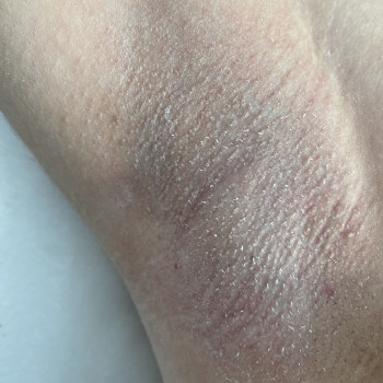 Результат після воскової депіляції протримається до 1,5 тижні.

 
 