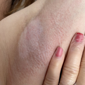 Робота воском може бути наскільки делікатною, що вразлива шкіра може це ніяк не відчути. 
Фото «післ...