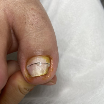 Корегування деформації нігтя Титановою ниткою