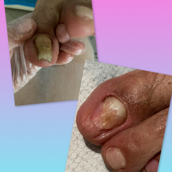 Оніхогрифоз нігтя