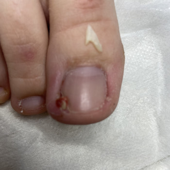 Вросший ніготь