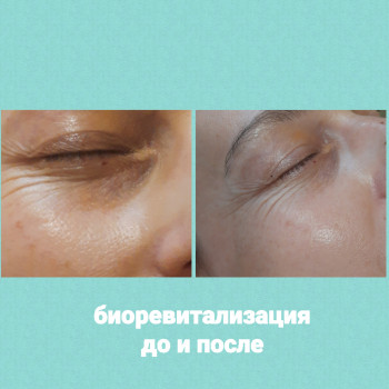  #биоревіталізацияодесса
 #полінуклеотидиодеса