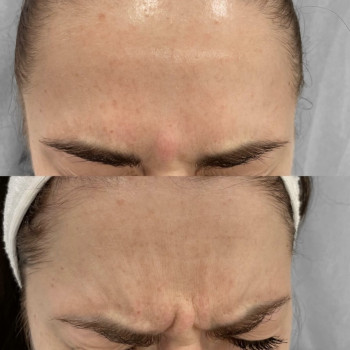 ботокс межбрівка