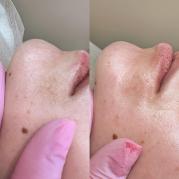 Чистка обличчя+поверхневий пілінг
                    Майстер з пірсингу Анна Київ