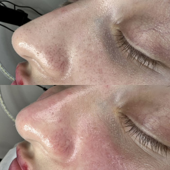 Чистка обличчя+поверхневий пілінг
                    Майстер з пірсингу Анна Київ