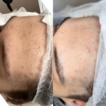 Чистка обличчя+поверхневий пілінг
                    Майстер з пірсингу Анна Київ