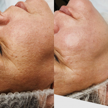 Чистка обличчя+поверхневий пілінг
                    Майстер з пірсингу Анна Київ