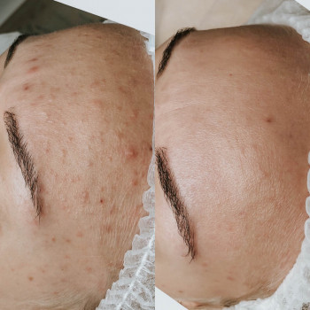 Чистка обличчя+поверхневий пілінг
                    Майстер з пірсингу Анна Київ