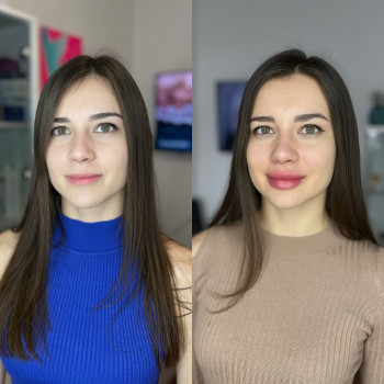 Збільшення губ Контурна пластика губ
                    Мастер по пирсингу Анна Киев