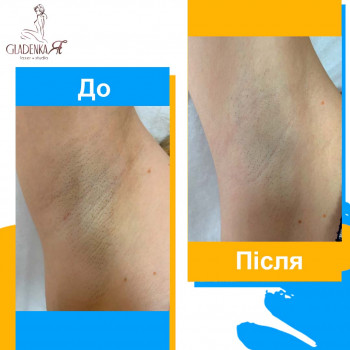 Лазерна епіляція пахв на діодному лазері з підтвердженою результативністю. 1000+ позитивних відгуків клієнтів.
 #лазернаепіляціяпахви #лазернаепіляція #епіляція
