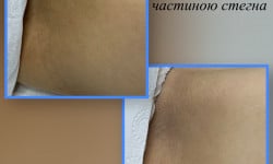 Відбілювання інтимних (делікатних) зон Електролог  Рівне