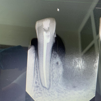 Ендодонтія. Лікування каналів.
  каналів
 