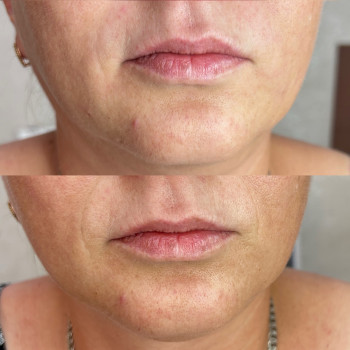 Контурна пластика обличчя
                    Косметолог-инъекционист Любов Запорожье