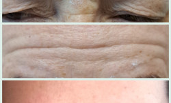 Ботулінотерапія Косметолог-естетист Елена Житомир