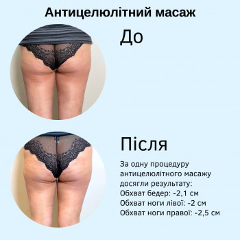 За одну процедуру антицелюлітного масажу досягли результату:
Обхват бедер: -2,1 см
Обхват ноги лівої: -2 см
Обхват ноги правої: -2,5 см

 #масаж #антицелюлітниймасаж #масажлівобережна