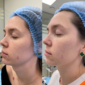 1 процедура