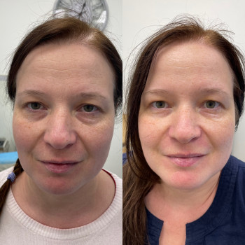 1 процедура