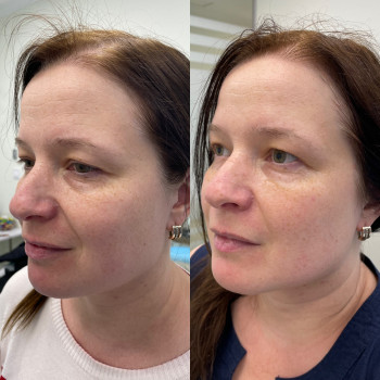 1 процедура