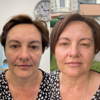 1 процедура