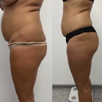 Процедури для боротьби з целлюлітом
                    Косметолог-инъекционист Дарья Ивано-Франковск