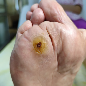 Видалення мозолів
                    Майстер манікюру Анна Бондаревская Харків