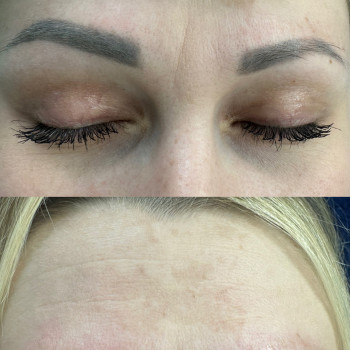 Видалення лазером
                    Мастер перманентного макияжа Людмила Бровары