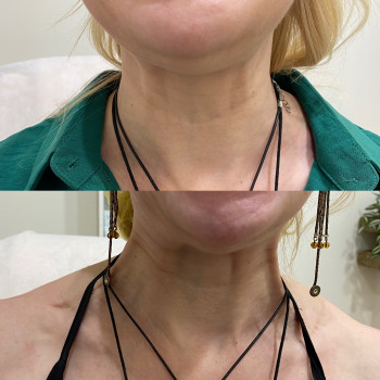 Ботулінотерапія фул фейс
 