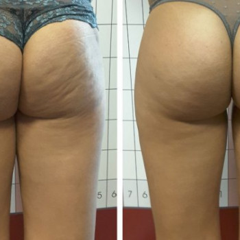 Процедури проти целюліту. Ліполітики проти целюліту

 