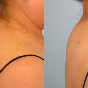 Вдовий горб. Ліполітична терапія