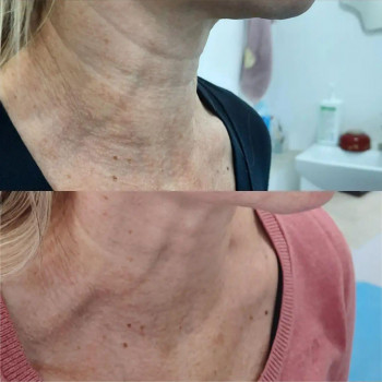 Микроигольчатый РФ лифтинг
                    Косметолог-инъекционист Наталия Павлова Одесса