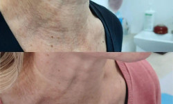 Микроигольчатый РФ лифтинг Косметолог-ін'єкціоніст Наталия Павлова Одеса