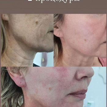 Микроигольчатый РФ лифтинг
                    Косметолог-инъекционист Наталия Павлова Одесса