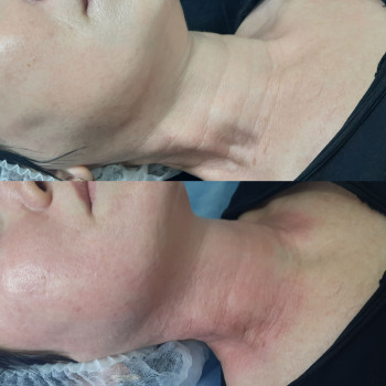 Микроигольчатый РФ лифтинг
                    Косметолог-инъекционист Наталия Павлова Одесса