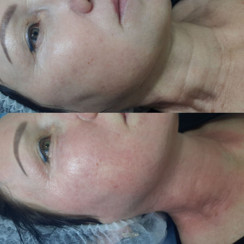 Микроигольчатый РФ лифтинг 
   