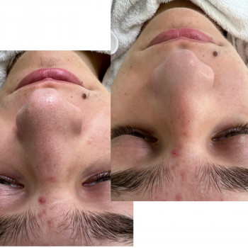 Чистка лица
                    Косметолог-инъекционист Наталья Днепр