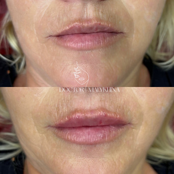 Контурна пластика губ
                    Врач-косметолог Ирина Краматорск